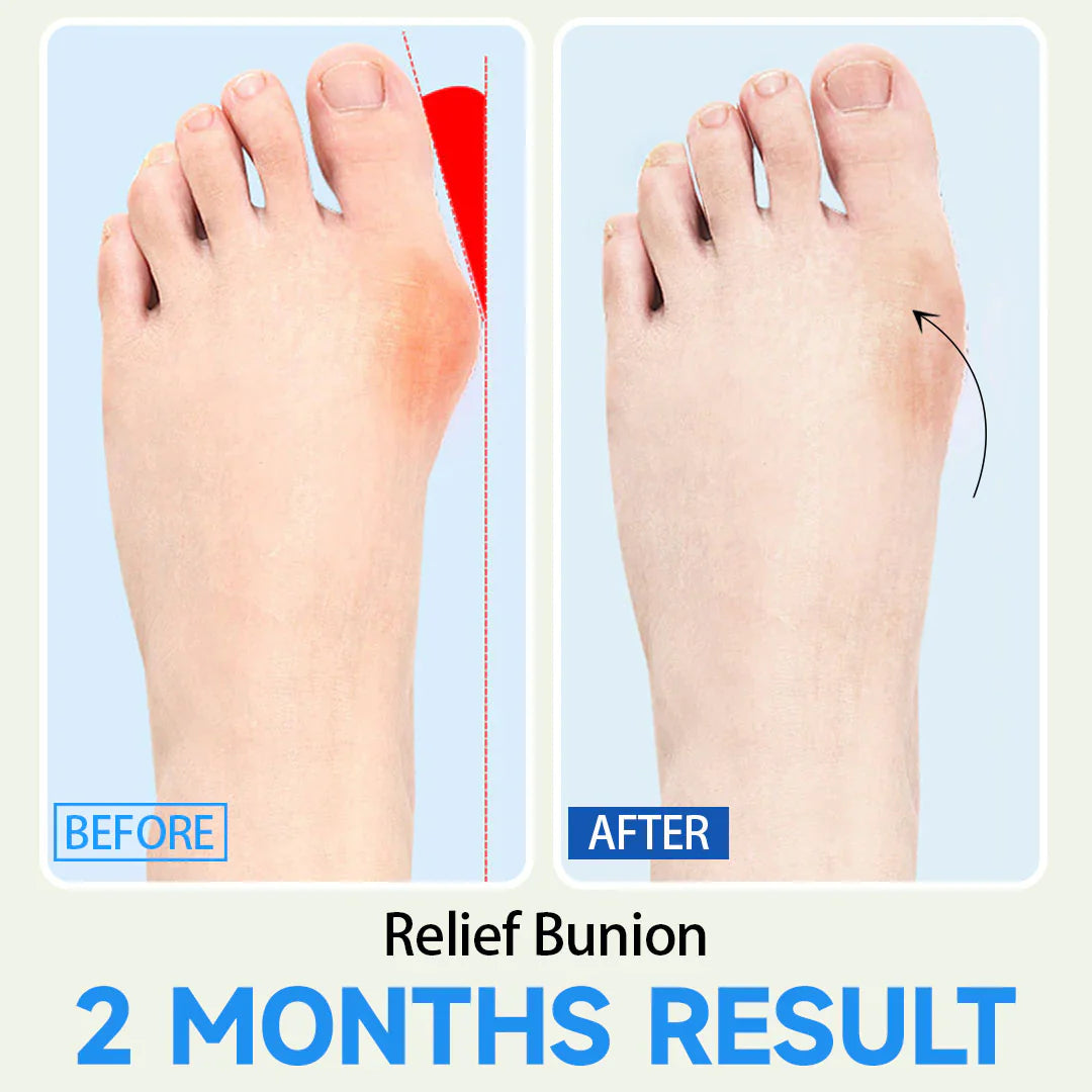 Foot health and bunion corrector