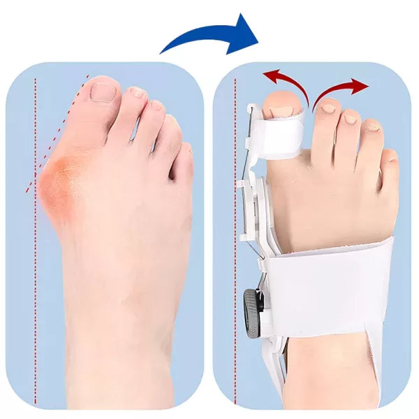 ZenAlign™ Adjustable Bunion Corrector